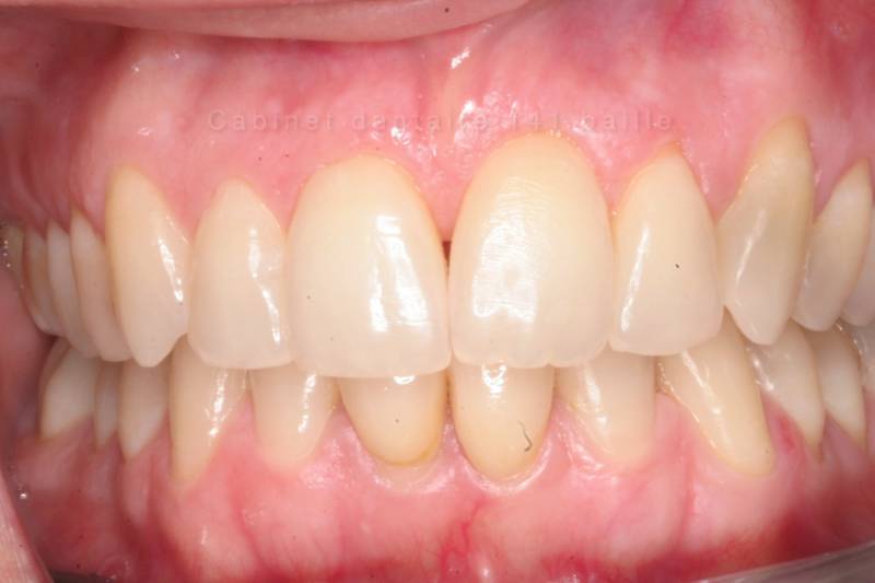 cas invisalign postop docteur tourrolier didier