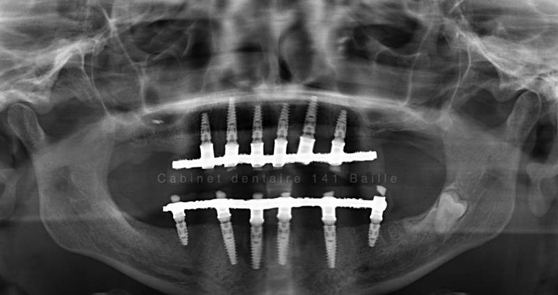 Chirurgie osseuse et greffe osseuses dentaire Marseille