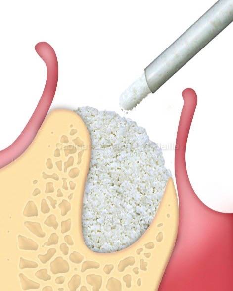 pose d'implant dentaire et greffe d'os simultannée