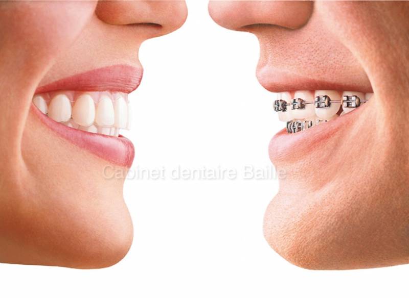 Aligner ses dents sans appareil.MARSEILLE .Technique INVISALIGN®.Dr TOURROLIER didier .