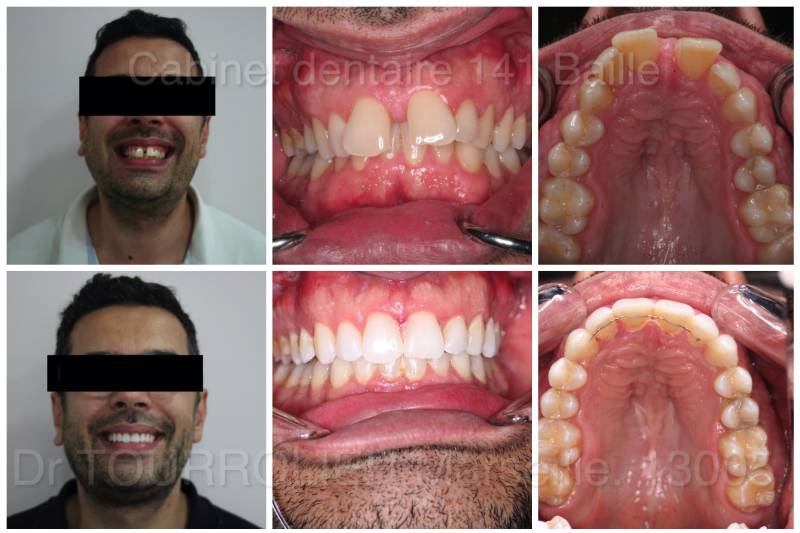 Supprimer espace entre les dents avec invisalign à marseille