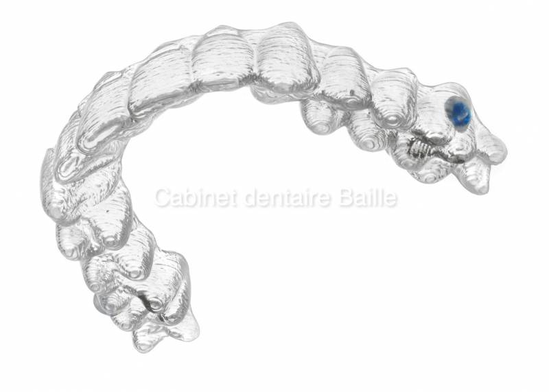 Prix gouttiières orthodontiques invisibles .Dr TOURROLIER DIdier.