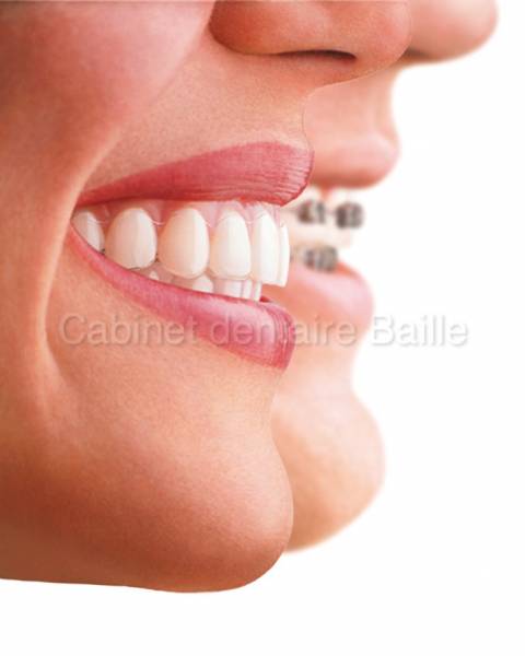 Orthodontie adulte esthétique Marseille.Dr TOURROLIER DIdier.