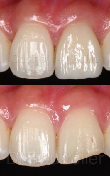 dentsite spécialiste des facettes dentaires sur Marseille
